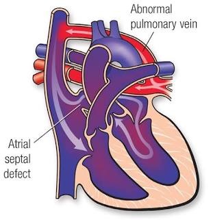 TAPVC বা জন্মগত জটিল হৃদরোগের গাঠনিক চিত্র. Source: American Heart Association
